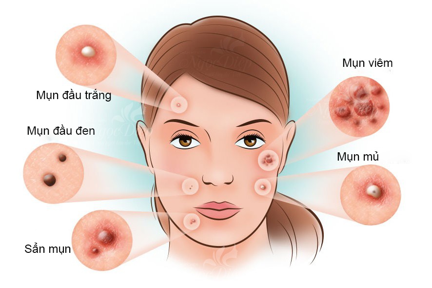 7. Các Sản Phẩm Trị Mụn Được Ưa Chuộng